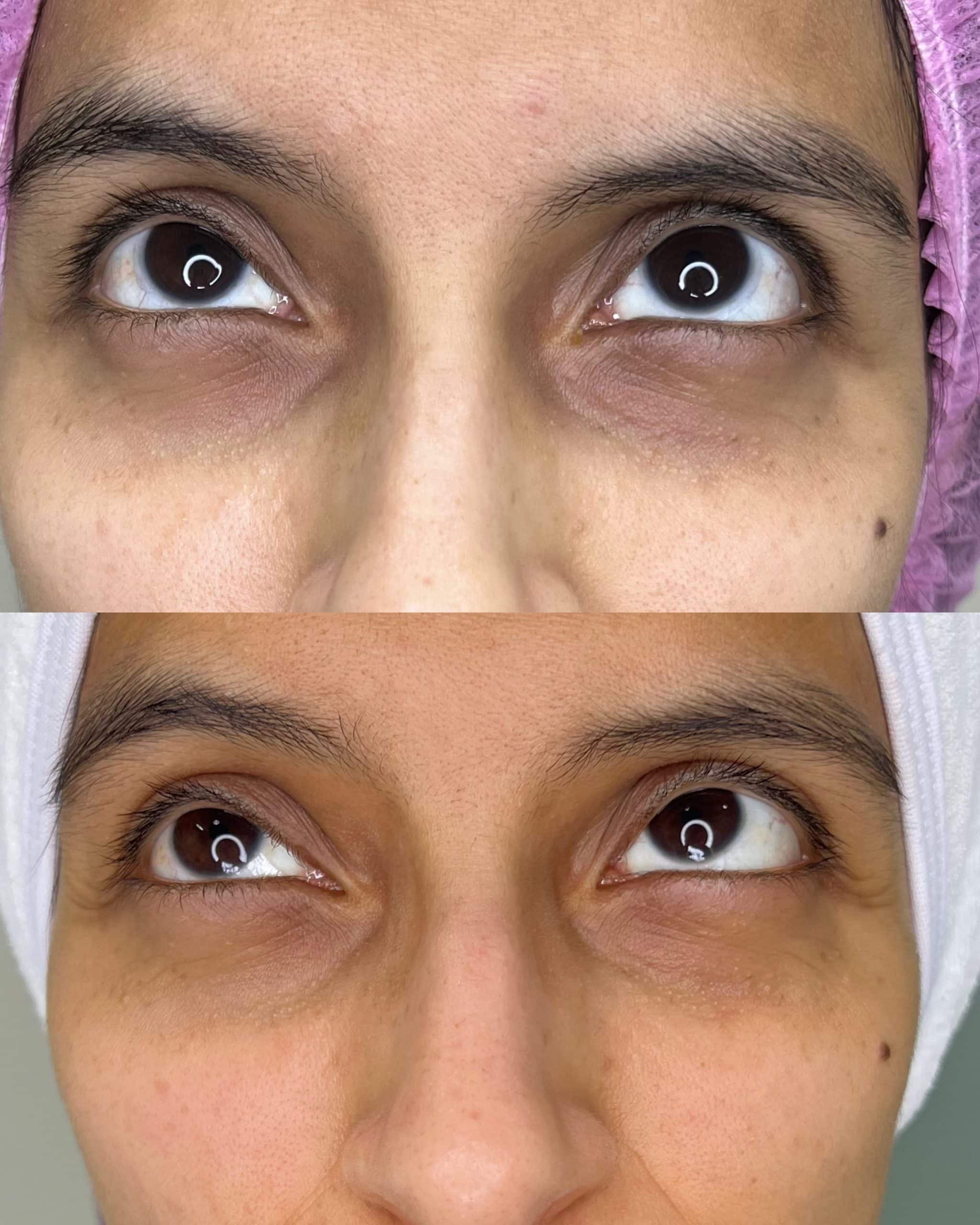 Copia de Aclaramiento ojeras