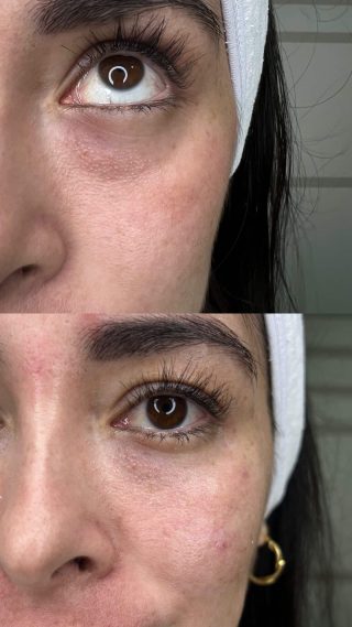 Copia de hundimiento ojera