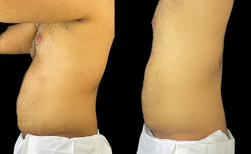 Hidrolipoclasia 1 gallery