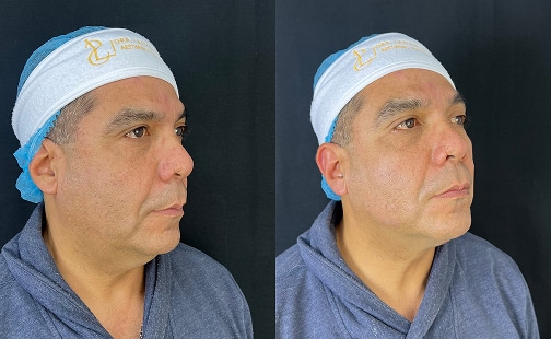 Rejuvenecimiento de Cuello y Escote 1 gallery